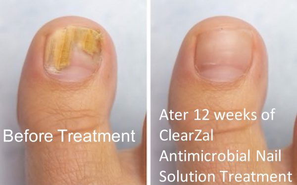 CLEARZAL ® Solución antimicrobiana para uñas